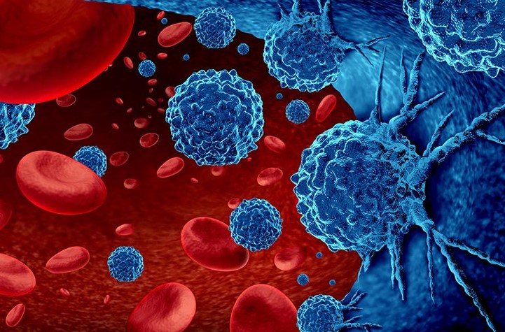 Що таке лейкоз крові