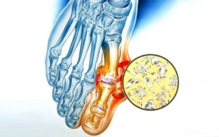 Що таке подагра