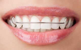 Що таке ретейнери