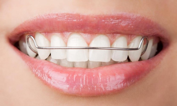 Що таке ретейнери