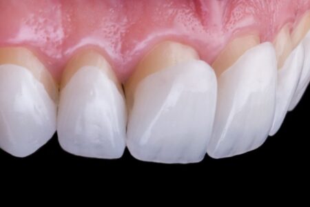 Що таке Вініри