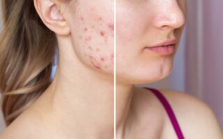 Що таке акне