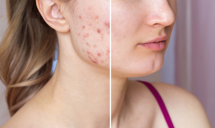 Що таке акне
