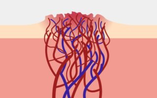 Гемангіома що це таке