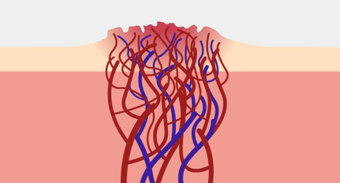 Гемангіома що це таке