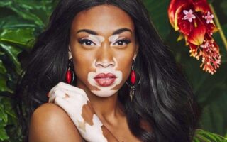 Вітіліго: що це таке