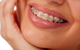 Дуга для брекетов: что это такое