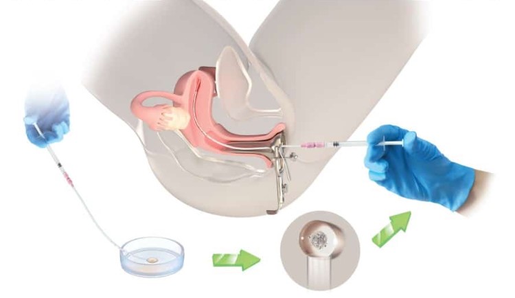 Как лечат бесплодие у женщин