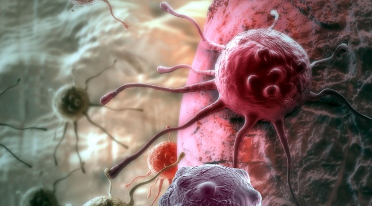 Що таке рецидив раку