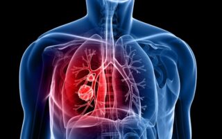 Що таке ХОЗЛ