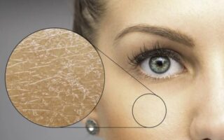 Іхтіоз: що це за хвороба