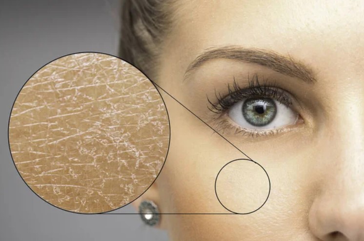 Іхтіоз: що це за хвороба